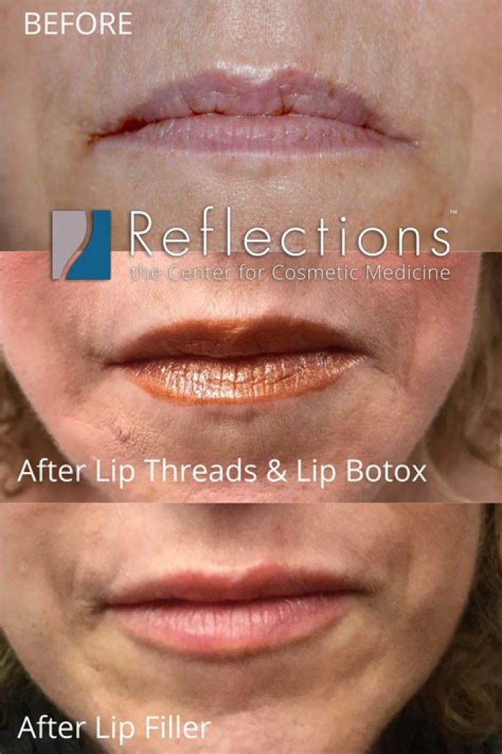 Ines Helene Before Plastic Surgery | Botox And Lip Filler