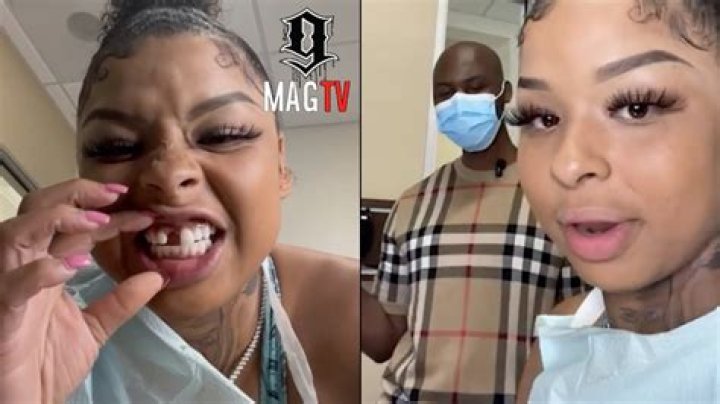 What Happened To Chrisean Rock’s Tooth? Everything To Know About The Rapper